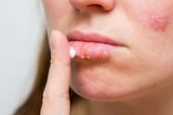 Cold sore and pimple (Image via BOY_ANUPONG/Getty Images)